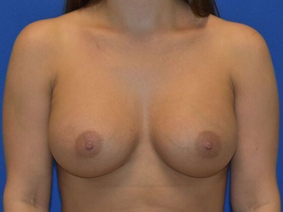 Breast Augmentation Case 13 - After