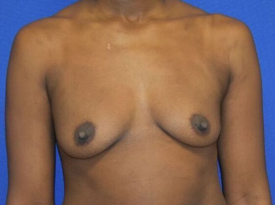 Breast Augmentation Case 14 - Before