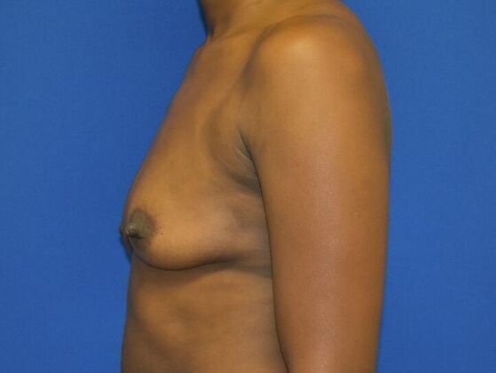 Breast Augmentation: Case 14 - Before