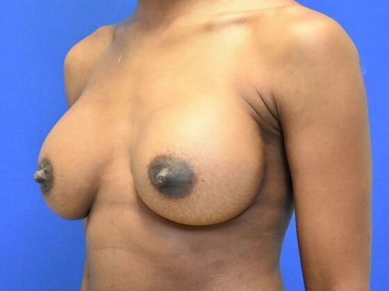 Breast Augmentation: Case 14 - After