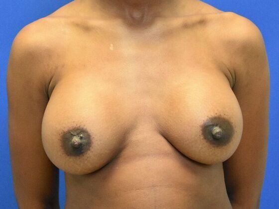 Breast Augmentation Case 14 - After