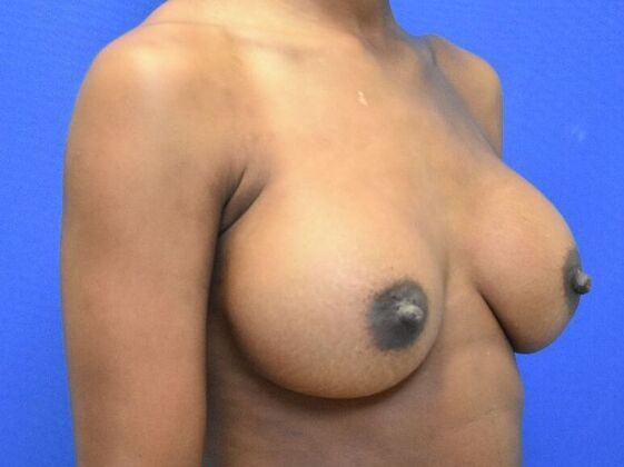 Breast Augmentation: Case 14 - After