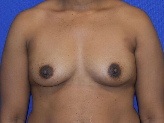 Breast Augmentation Case 15 - Before