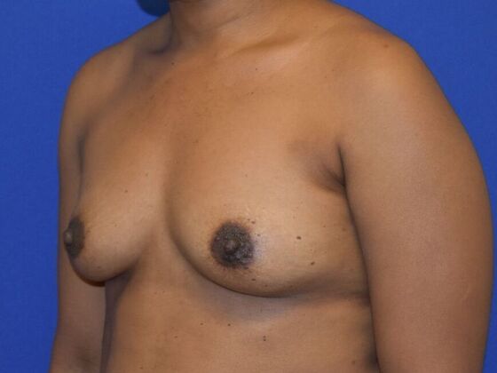 Breast Augmentation: Case 15 - Before