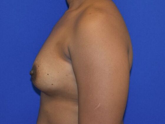 Breast Augmentation: Case 15 - Before
