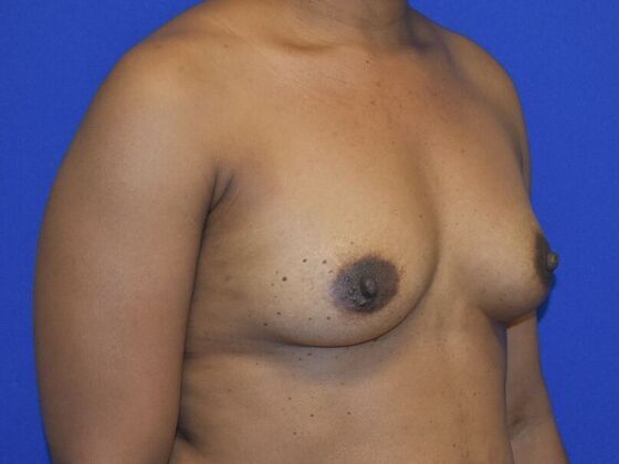 Breast Augmentation: Case 15 - Before