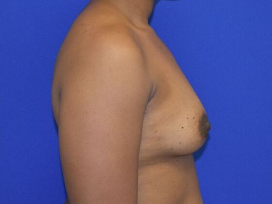 Breast Augmentation: Case 15 - Before