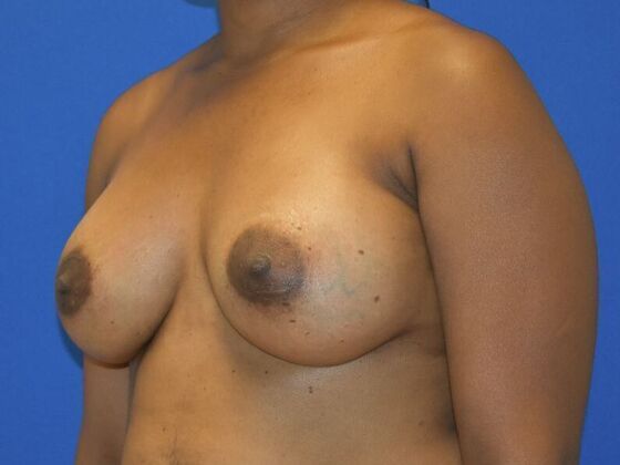 Breast Augmentation: Case 15 - After