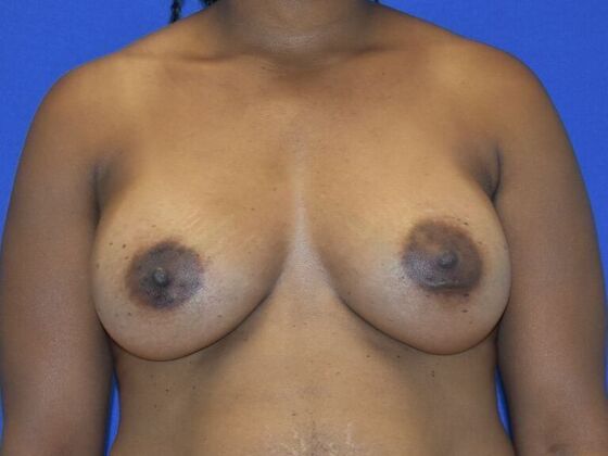 Breast Augmentation Case 15 - After