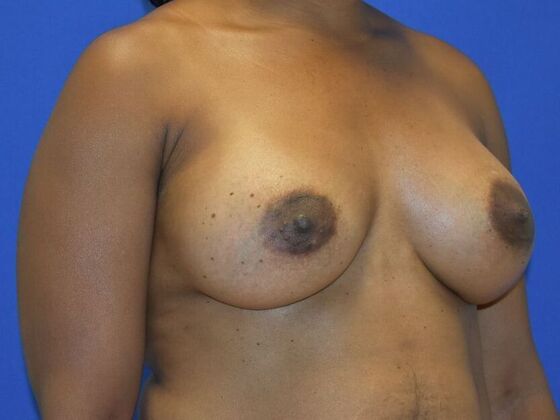 Breast Augmentation: Case 15 - After