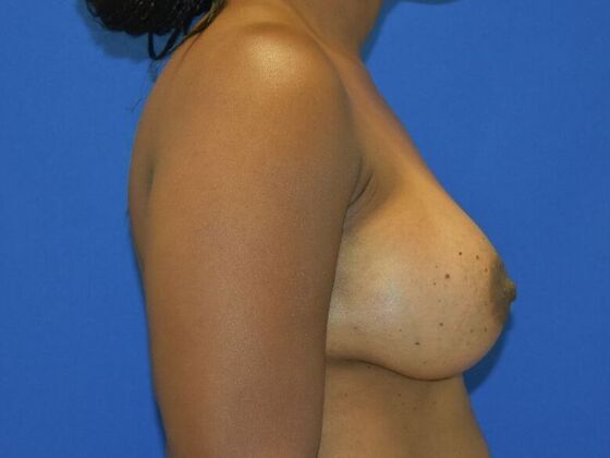 Breast Augmentation: Case 15 - After