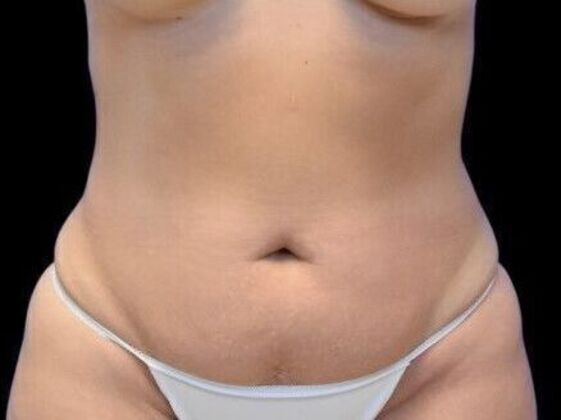 Tummy Tuck with Contouring Case 5 - Before