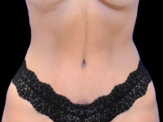 Tummy Tuck with Contouring Case 5 - After