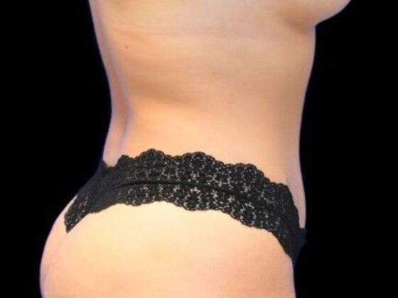 Tummy Tuck with Contouring: Case 5 - After