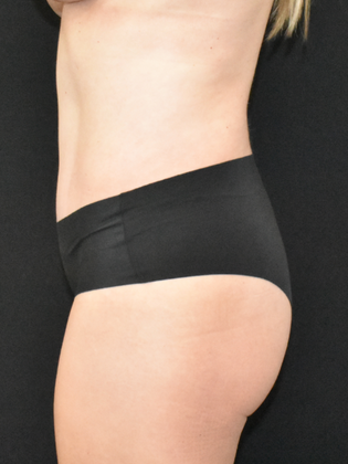 Abdominoplasty: Case 24 - After