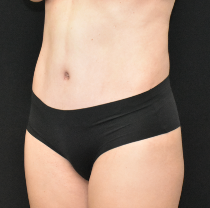 Abdominoplasty: Case 24 - After