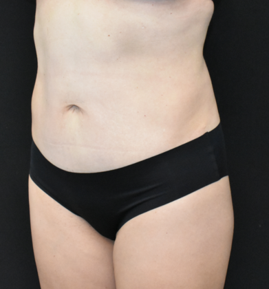 Abdominoplasty: Case 24 - Before
