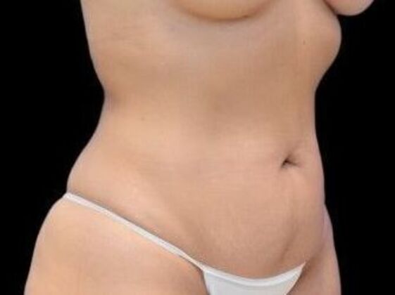Tummy Tuck with Contouring: Case 5 - Before