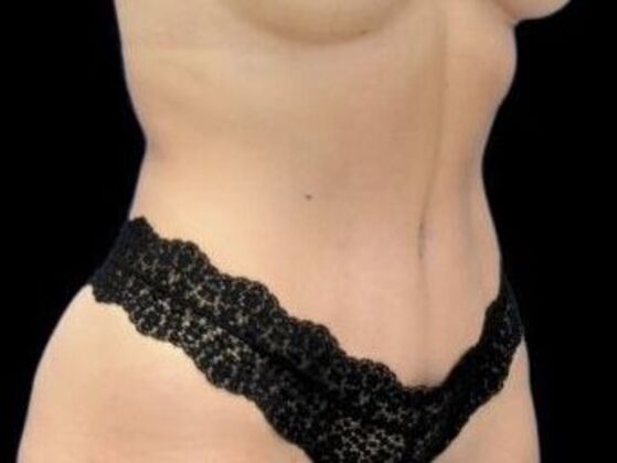 Tummy Tuck with Contouring: Case 5 - After