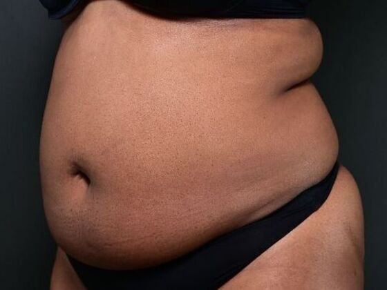 Tummy Tuck with Contouring: Case 6 - Before