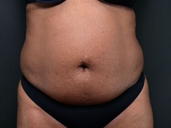 Tummy Tuck with Contouring Case 6 - Before