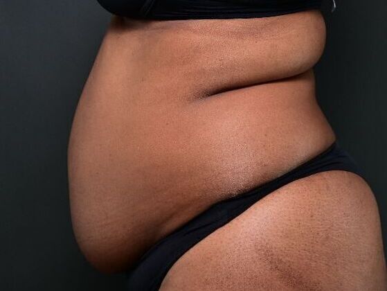 Tummy Tuck with Contouring: Case 6 - Before