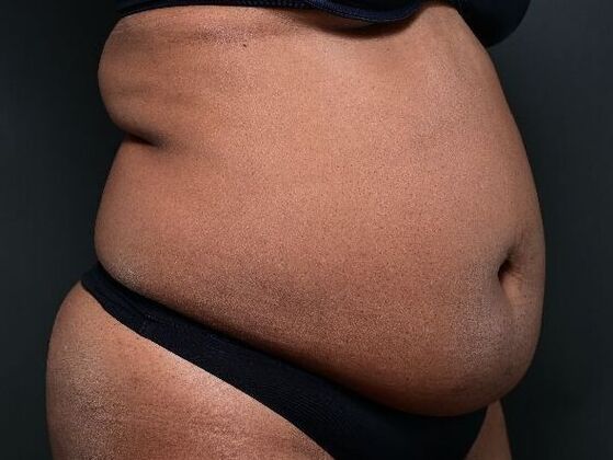 Tummy Tuck with Contouring: Case 6 - Before