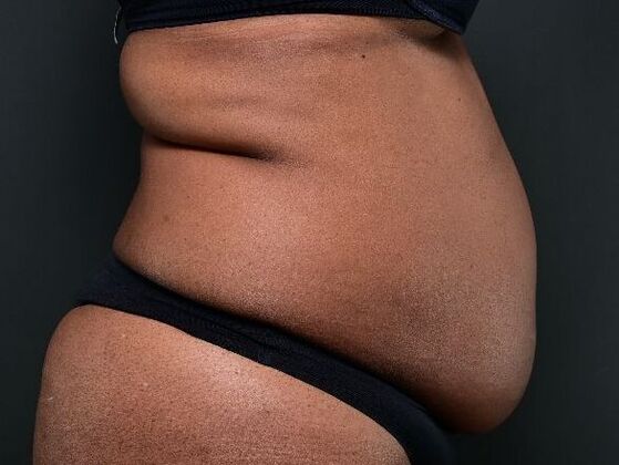 Tummy Tuck with Contouring: Case 6 - Before