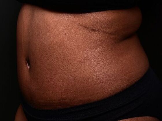 Tummy Tuck with Contouring: Case 6 - After