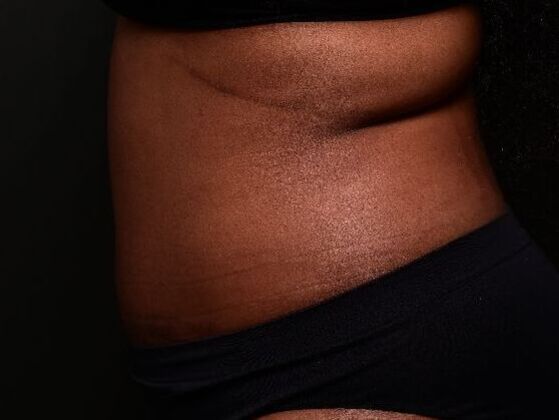 Tummy Tuck with Contouring: Case 6 - After