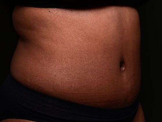 Tummy Tuck with Contouring: Case 6 - After