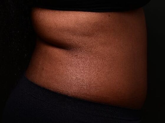 Tummy Tuck with Contouring: Case 6 - After