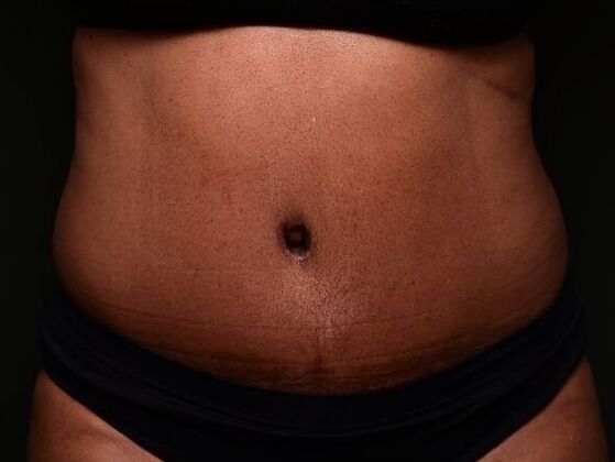 Tummy Tuck with Contouring Case 6 - After