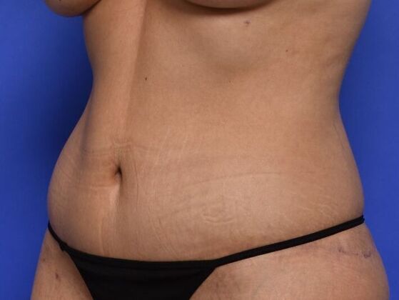 Tummy Tuck with Contouring: Case 7 - After