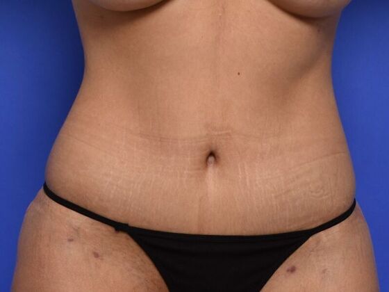 Tummy Tuck with Contouring Case 7 - After