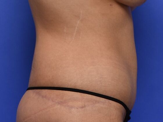 Tummy Tuck with Contouring: Case 7 - After