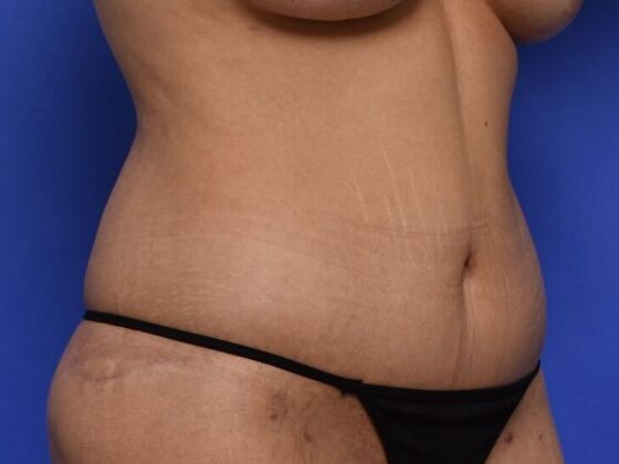 Tummy Tuck with Contouring: Case 7 - After