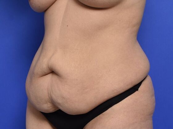 Tummy Tuck with Contouring: Case 7 - Before