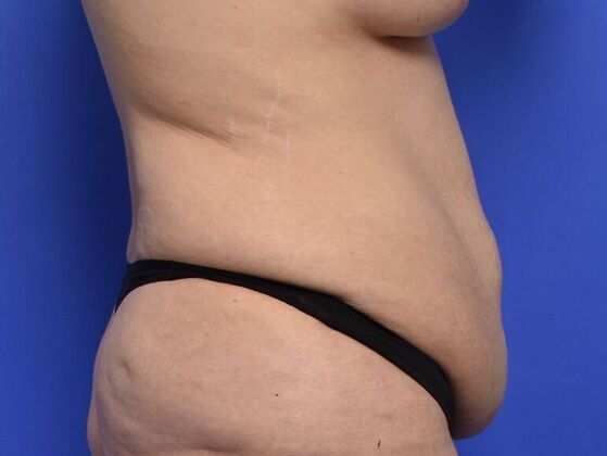 Tummy Tuck with Contouring: Case 7 - Before