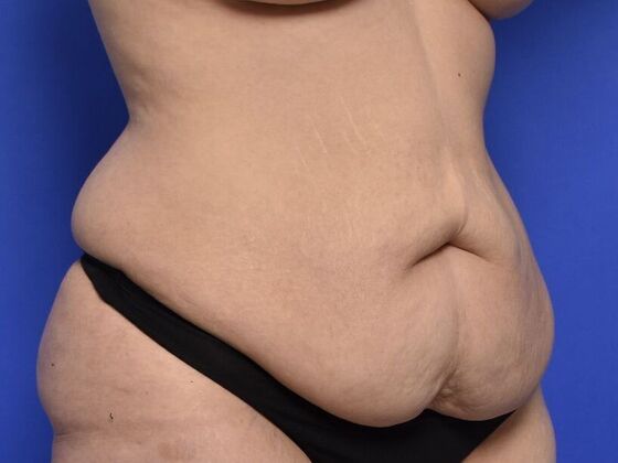 Tummy Tuck with Contouring: Case 7 - Before