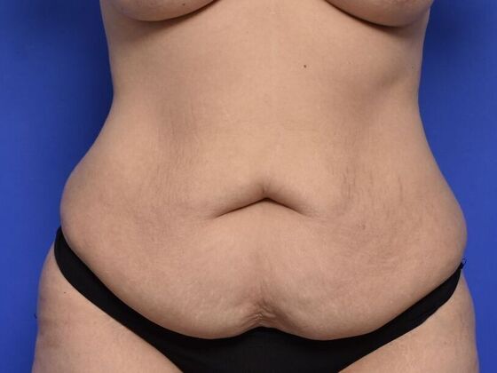 Tummy Tuck with Contouring Case 7 - Before