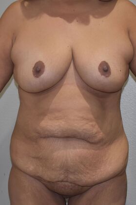 Mommy Makeover Case 333 - Before