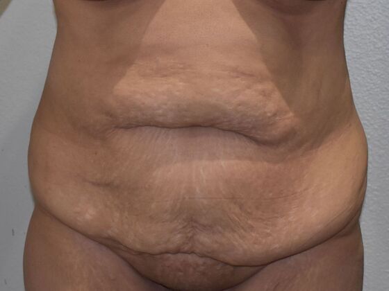 Tummy Tuck (Abdominoplasty): Case 523 - Before