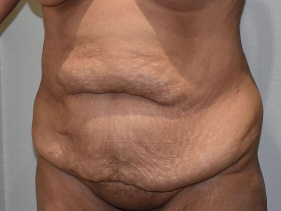 Tummy Tuck (Abdominoplasty): Case 523 - Before