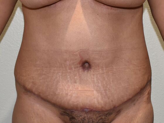 Tummy Tuck (Abdominoplasty): Case 523 - After