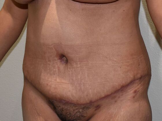 Tummy Tuck (Abdominoplasty): Case 523 - After