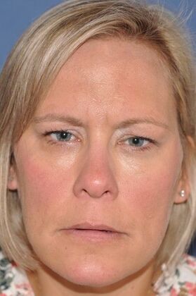 Endoscopic Browlift: Endoscopic Browlift and Upper Lids revealing lovely natural eye shape - Before