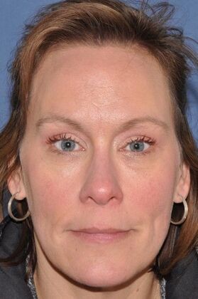 Endoscopic Browlift: Endoscopic Browlift and Upper Lids revealing lovely natural eye shape - After