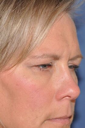 Endoscopic Browlift: Endoscopic Browlift and Upper Lids revealing lovely natural eye shape - Before