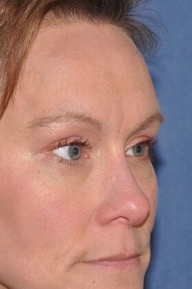 Endoscopic Browlift: Endoscopic Browlift and Upper Lids revealing lovely natural eye shape - After
